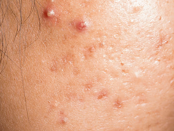Close-up of skin with small red bumps and lesions.