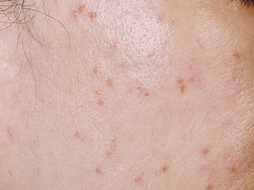 Close-up of skin with acne and blemishes
